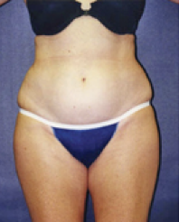 Liposuction Before