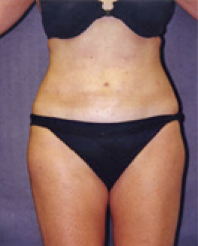 Liposuction After