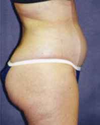 Liposuction Before