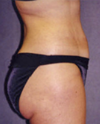 Liposuction After