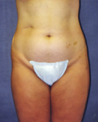 Liposuction Before