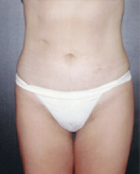 Liposuction After