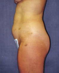 Liposuction Before