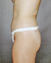 Liposuction After