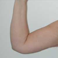 Arm Lift After