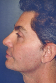 Male Facial Procedures After