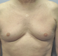 Male Body Contouring Before