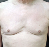 Male Body Contouring After