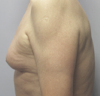 Male Body Contouring Before