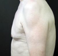 Male Body Contouring After