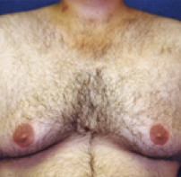 Male Body Contouring Before