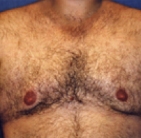 Male Body Contouring After