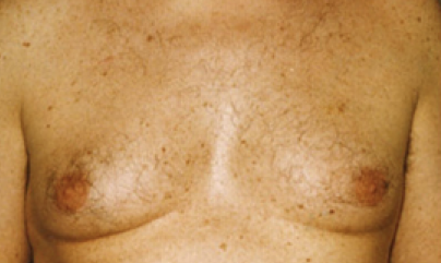 Male Body Contouring Before