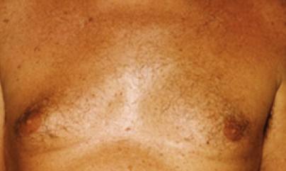 Male Body Contouring After