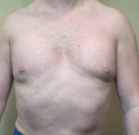 Male Body Contouring Before