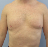 Male Body Contouring After