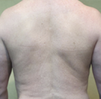 Male Body Contouring Before