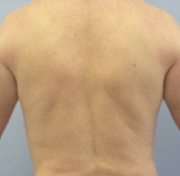 Male Body Contouring After