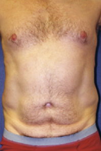 Male Body Contouring Before