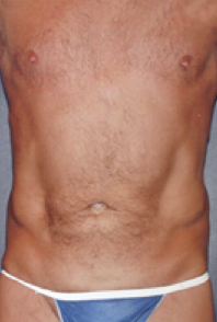 Male Body Contouring After