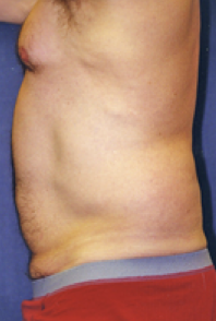 Male Body Contouring Before