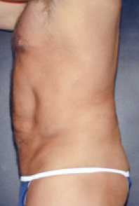 Male Body Contouring After