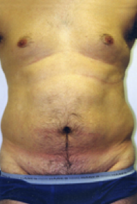 Male Body Contouring Before