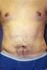 Male Body Contouring After