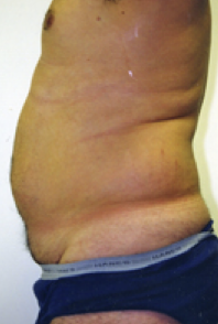 Male Body Contouring Before