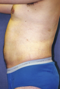 Male Body Contouring After