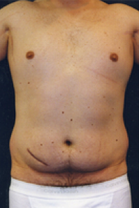 Male Body Contouring Before