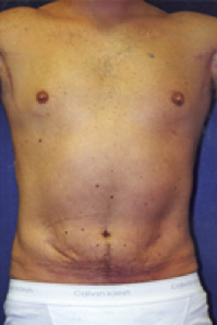 Male Body Contouring After