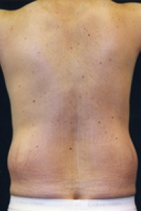 Male Body Contouring Before