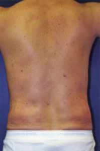 Male Body Contouring After