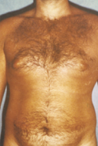 Male Body Contouring Before