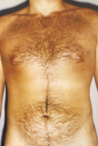 Male Body Contouring After