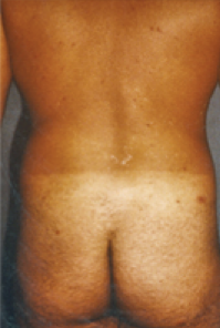 Male Body Contouring Before