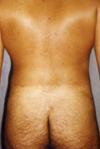 Male Body Contouring After