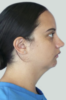 Neck Liposuction, Platysmaplasty, Chin Implant Before