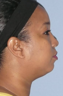 Neck Liposuction, Platysmaplasty, Chin Implant Before