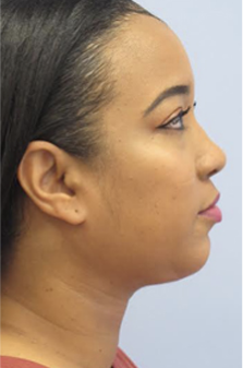 Neck Liposuction, Platysmaplasty, Chin Implant After