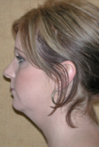 Neck Liposuction, Platysmaplasty, Chin Implant Before