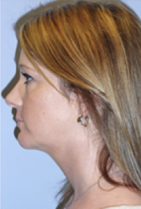 Neck Liposuction, Platysmaplasty, Chin Implant After