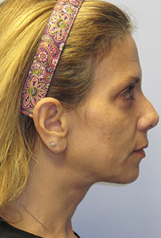 Neck Liposuction, Platysmaplasty, Chin Implant After