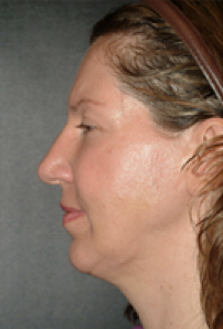 Neck Liposuction, Platysmaplasty, Chin Implant Before