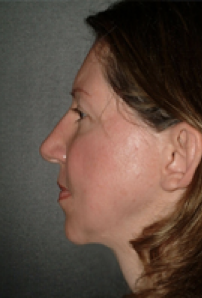 Neck Liposuction, Platysmaplasty, Chin Implant After