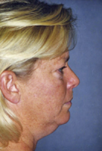 Neck Liposuction, Platysmaplasty, Chin Implant Before