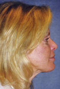 Neck Liposuction, Platysmaplasty, Chin Implant After