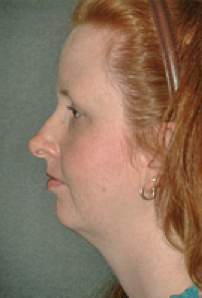 Neck Liposuction, Platysmaplasty, Chin Implant Before