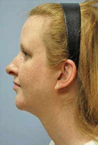 Neck Liposuction, Platysmaplasty, Chin Implant After